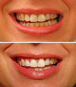 SUPER BLANUQEAMENTO DENTAL DESDE 50.000 PESOS!! BOGOTA, COLOMBIA