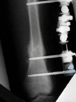Clnica Especializada en Fracturas que presentan no uni Bogota, Colombia