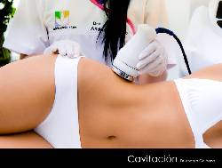 CAVITACION - LIPOESCULTURA SIN CIRUGA BOGOTA, COLOMBIA