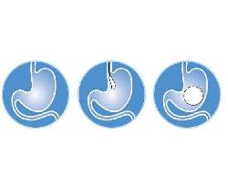 BIB SYSTEM tratamiento endoscopico eficaz y seguro Cali, Colombia