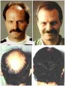 Cada del cabello tratamiento Minoxidil Colombia Ibague, colombia
