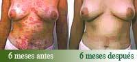 TRATAMIENTO DE LA PSORIASIS Bogot, Colombia