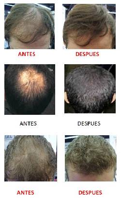NO MAS CALVICIE EN TAN SOLO 30 SEG.  Boom Boo Hair Bogot, Colombia
