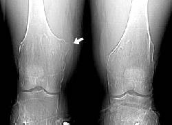 Encondromatosis manejo y diagnsticos efectivos Bogot D.C., Colombia