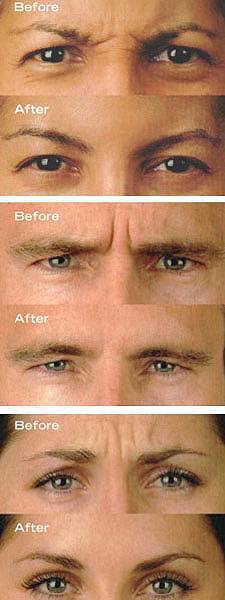 BOTOX 2X1 A MITAD DE PRECIO SOLO EN PROFORMA MEDIC Bogota, Colombia