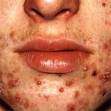 ACNE -ROSACEA -SEBORREA LIMA, PERU