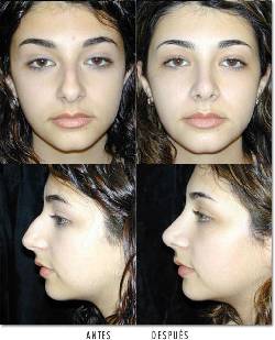 corrector nasal su nariz perfecta sin cirugia bogota, colombia