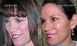 Faciales rejuvenecedores Corporales modeladores Iztapalapa D.F., Mxico