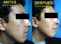 TRATAMIENTO DE ACNE EN LIMA PERU, POR DERMATOLOGO Lima, Peru